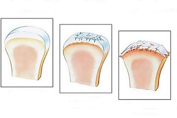 poškodenie kĺbov v rôznych štádiách vývoja artrózy