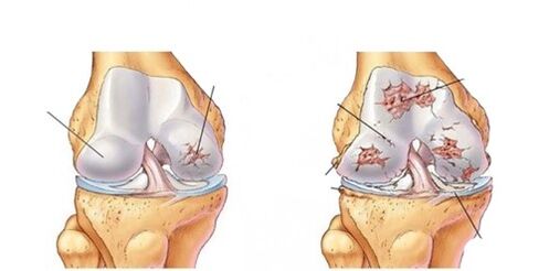 deformujúca artróza kolena