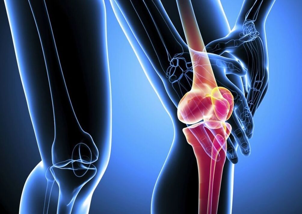 Bolesť pri fyzickej aktivite pri artróze kolenného kĺbu