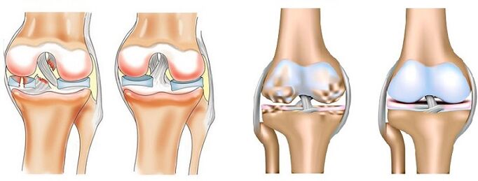 Rozdiel medzi artritídou (vľavo) a artrózou (vpravo) kĺbov
