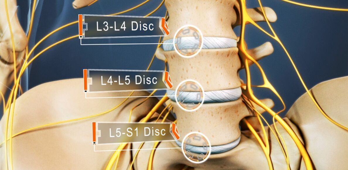 Disky bedrovej chrbtice, ktoré sú najčastejšie postihnuté pri osteochondróze