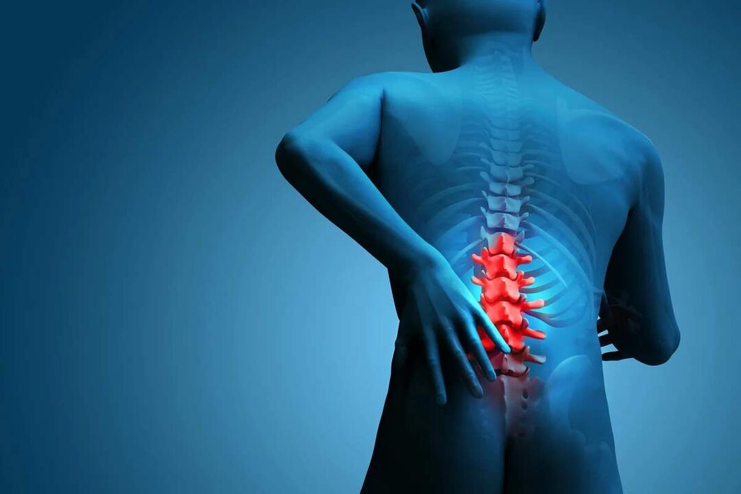 Hlavným príznakom osteochondrózy bedrovej chrbtice je bolesť v dolnej časti chrbta. 