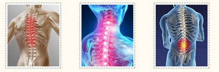 osteochondróza rôznej chrbtice