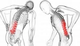 Medzistavca prietrž - Komplikácia s osteochondrózou