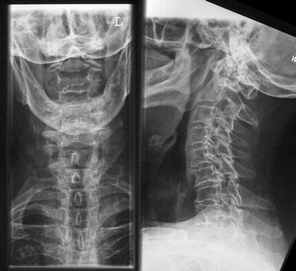 Cervikálny x -ray - metóda diagnostiky osteochondrózy