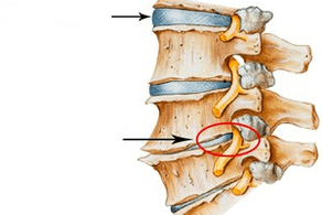 Normálna a poškodená miecha s cervikálnou osteochondrózou