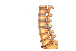 Poškodenie chrbtice s cervikálnou osteochondrózou