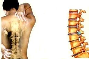 bolesť chrbta v rôznych štádiách rozvoja krčnej osteochondrózy