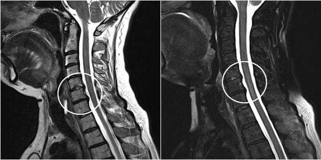 MRI krčnej chrbtice