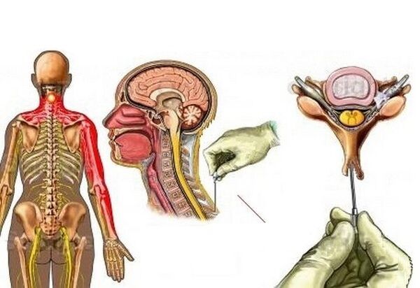 liečba cervikálnej osteochondrózy akupunktúrou