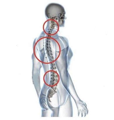 miesta osteochondrózy chrbtice