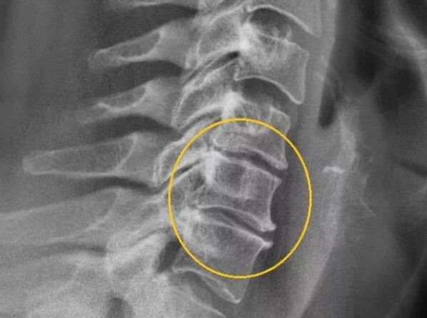 Osteochondróza krčnej chrbtice na röntgene